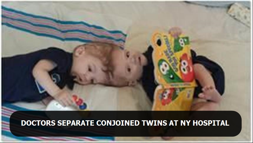 Doctors separate conjoined twins at NY hospital